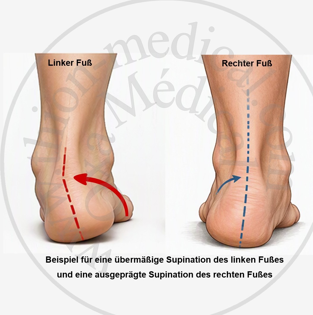 Foto von Füßen in Hyper-Supination